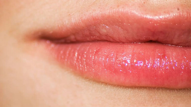 herpes labial